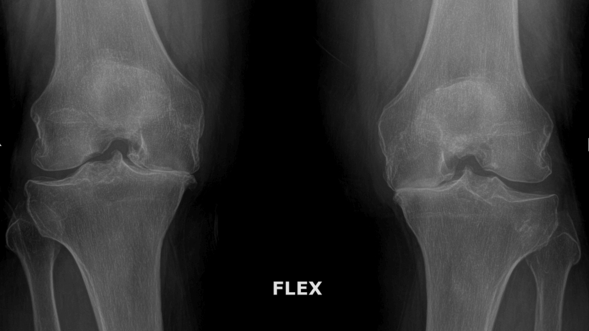 Knee Arthritis Xray